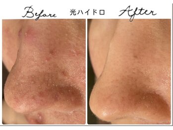 アリュール 倉敷(ALLURE)の写真/素肌に自信が持てる【毛穴の黒ずみ/開き/皮脂/徹底改善◎】繰り返すニキビや長年のニキビでお悩みの方に◎