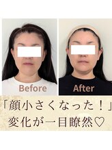 スウ(suu.)/Before-After【40代】2回目