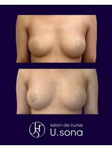 小顔・脂肪コントロール専門 salon de nurse U.sona～松本店～/【バストケア】脂肪増殖10cc