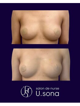 小顔・脂肪コントロール専門 salon de nurse U.sona～松本店～/【バストケア】脂肪増殖10cc