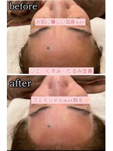 ルノン(LUNON)/国産WAXで産毛脱毛