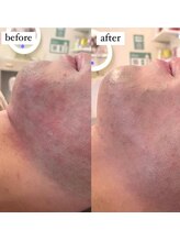 ビジュープラス ひたち野うしく店(Bijou+)/【肌荒れ/ニキビケア】