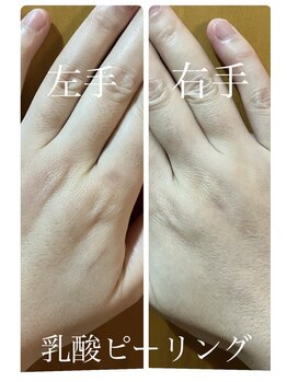 ニコリ(nicori)/乳酸ピーリング　beforeとafter