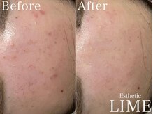 ライム 新宿三丁目(LIME)/ハーブピーリング|ニキビケア