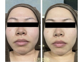 チャマ 高知店(CHAMA)/1回の即効性!20代 水光ピール