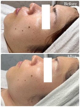 リアム(LiAm)/肌質改善 ララピール