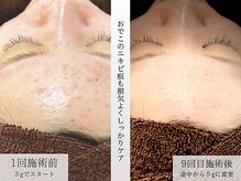 ホクビューティー(HOCU BEAUTY)の雰囲気（ハーブピーリングのおでこのにきびケアはやってよかった方多数!!）