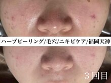 ホワイトアクア 福岡天神店(WHITE AQUA)/ハーブピーリングビフォー