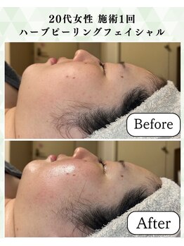 シーフェイス 横浜店(SEE FACE)/毛穴ケアハリツヤ肌トーンアップ