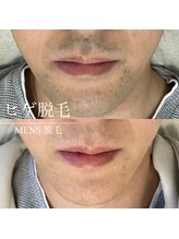 ディア(Dea)/ヒゲ脱毛