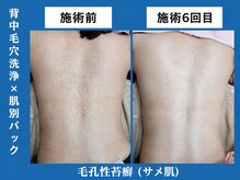 シェリー(Cheri)/【背中毛穴洗浄吸引+パック】