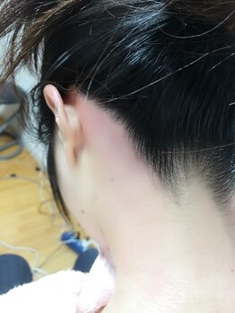 ウインドベル(windbell)/襟足ワックス脱毛後