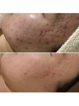 ハーナウ ハウ(hanau hou)/ハーブピーリング効果