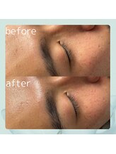 ソーヴ(SOLVE)/ピーリング/脱毛/シェービング