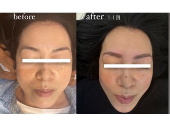 イル 名取店(iru)/光フェイシャル