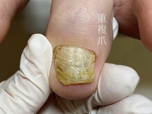 ニーヨンゼロ(240)/爪甲鉤灣・肥厚爪・重複爪