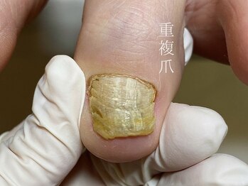 爪甲鉤灣・肥厚爪・重複爪