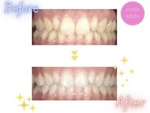 エクシアホワイトニング 静岡駅前店/ホワイトニングビフォーアフター