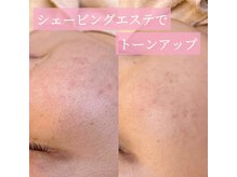 リンド エステ まつげ 京成大久保(Lind)/シェービングエステでトーンUP