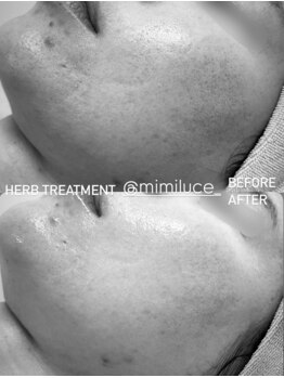 ミミルーチェ(mimiluce)/ハーブピーリング横浜/施術1回