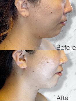 ルミライ(Lumirai)/二重顎無くしたくないですか?