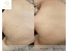 スキニティ 池袋(sknity)/<背中>ざらつき抑え質感整う美肌
