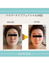 ニュウミー 諏訪本店(newme)/小顔　ビフォーアフター１