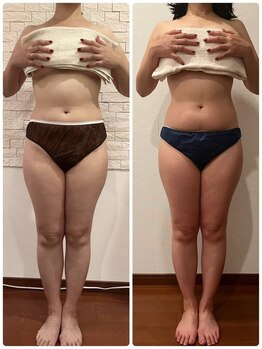 うつくし痩身 美サロン ゼットワン(Z-ONE)/筋膜リリースメディセル６回