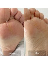 アイル(isle)/【魚の目でお悩み】のお客様