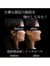 クリニカルボーテ 心斎橋院(CLINICAL BEAUTE)/頬がこけている方必須！