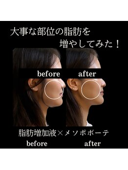 クリニカルボーテ 心斎橋院(CLINICAL BEAUTE)/頬がこけている方必須！