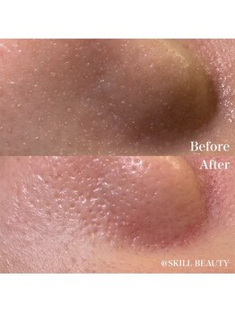 スキル アイラッシュ(SKILL eyelash)/ララ&毛穴洗浄beforeafter