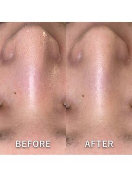 マーブルスタイル 横浜西口店(MARBLE STYLE)/【BeforeAfter】毛穴ケア体験