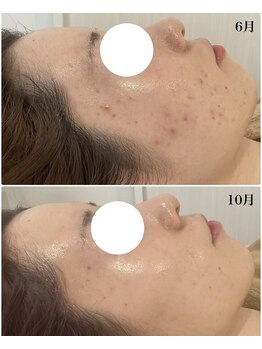 ミセル(MISEL2nd)/お肌のトーンアップにも効果的♪