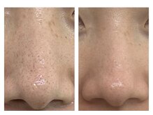 ザ ワン(THE ONE)/【ハイドラフェイシャル】　効果