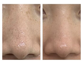 ザ ワン(THE ONE)/【ハイドラフェイシャル】 効果