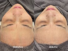 ウェルケアサロン(Wellcare Salon)の雰囲気（【60代女性2回目経過】くすみやシワが改善されお肌に透明感が♪）