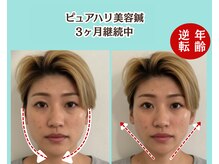 ピュアハリ/沖縄美容鍼 効果