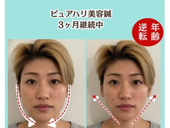 ピュアハリ/沖縄美容鍼 効果