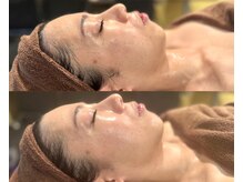 シェリー トウキョウ 西葛西店(Cherie Tokyo)/エラスチンB/A /西葛西/たるみ