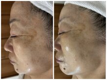 リクラ 北千住(Reclat)/REVIハーブピーリング＋