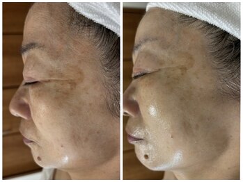 リクラ 北千住(Reclat)/REVIハーブピーリング＋