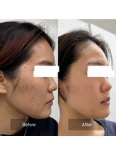 ファームディ(Pharm.D)/ニキビの根本改善はコレです