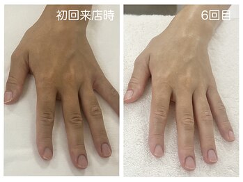キレイテ 上野店/50代/6回目【ハンドケア稲荷町】
