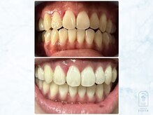 フルール(FLEUR)/セルフホワイトニング1回