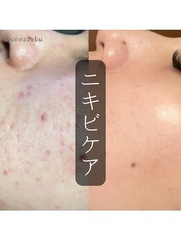 ディオーネ 麻布十番(Dione)/【ニキビケア】