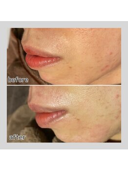 アデル 久留米(ADEL)/《部分》口周りワックス