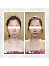 フローフシ∞/【小顔】40代女性症例写真