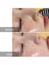 ヒヨリ(hiyori)/《before/after》毛穴洗浄