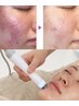 限定♪FACE人気NO1♪ニキビ・シミケア低刺激乳酸ピーリング¥13200→¥9999